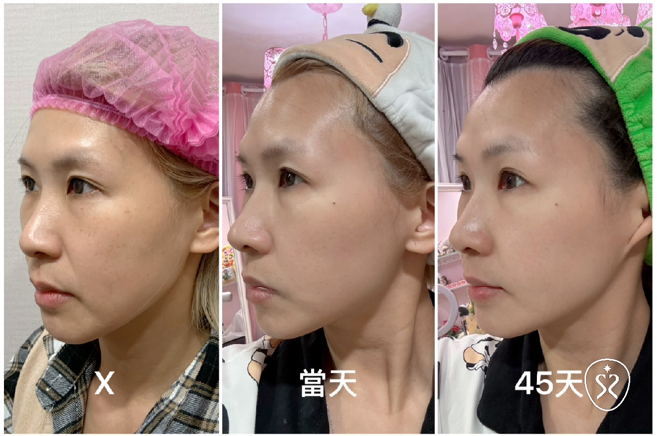 劉恭志醫師的專業技術與細心規劃，玩美電波的體驗既輕鬆又有效果